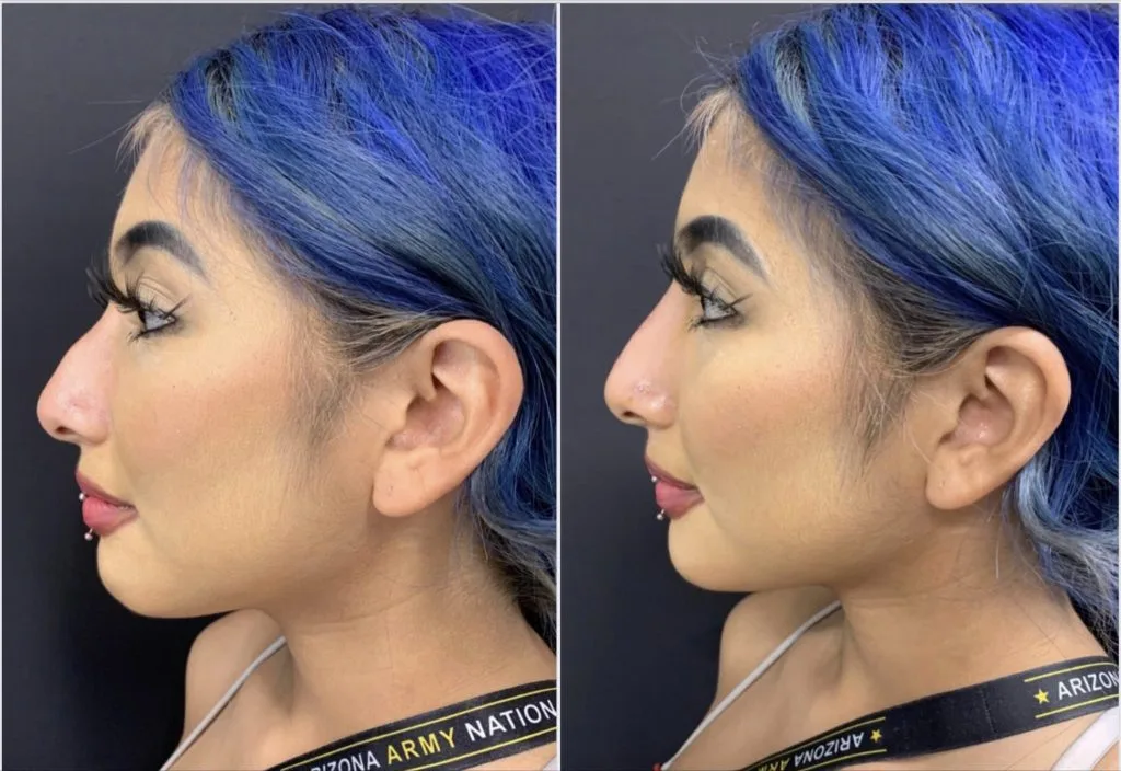 BEAUTIFUL NON-SURGICAL RHINOPLASTY Before & After Case Number 0005
