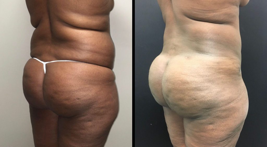BRAZILIAN BUTT LIFT Before & After Case Number 0002