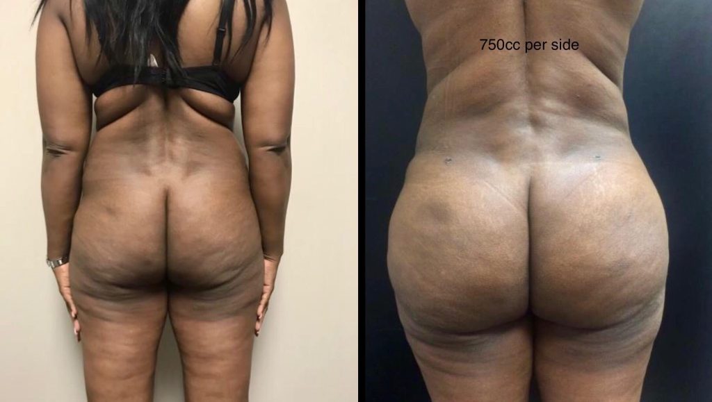 BRAZILIAN BUTT LIFT Before & After Case Number 0003
