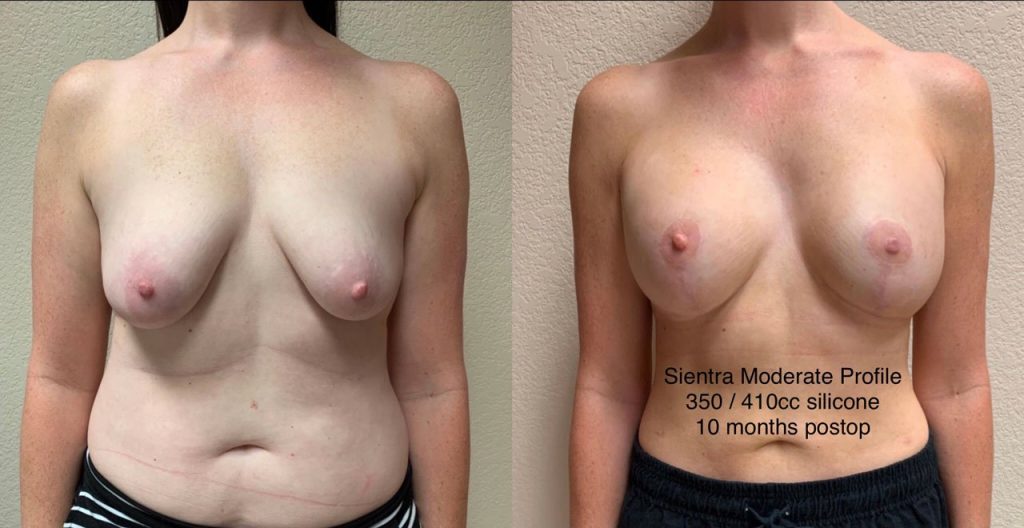 BREAST ASYMMETRY CORRECTION Before & After Case Number 0001