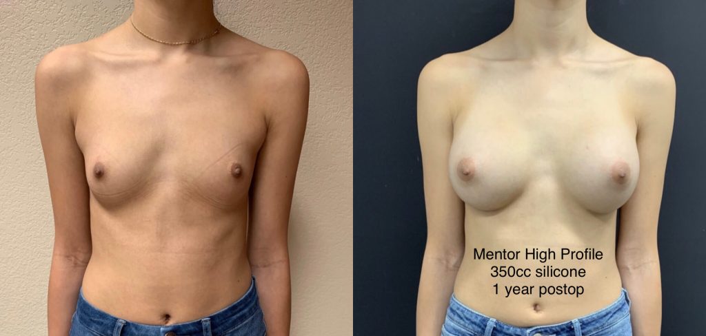 BREAST AUGMENTATION Before & After case 0001