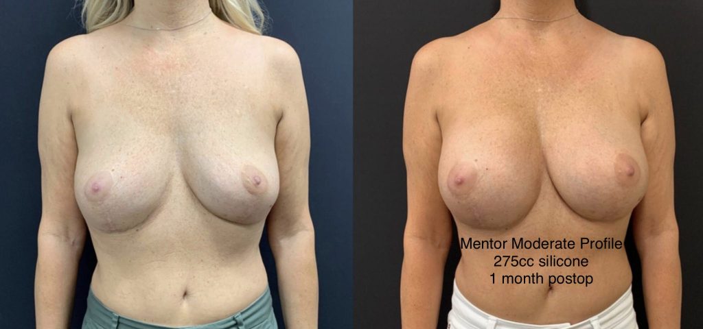 BREAST AUGMENTATION Before & After Case Number 00012