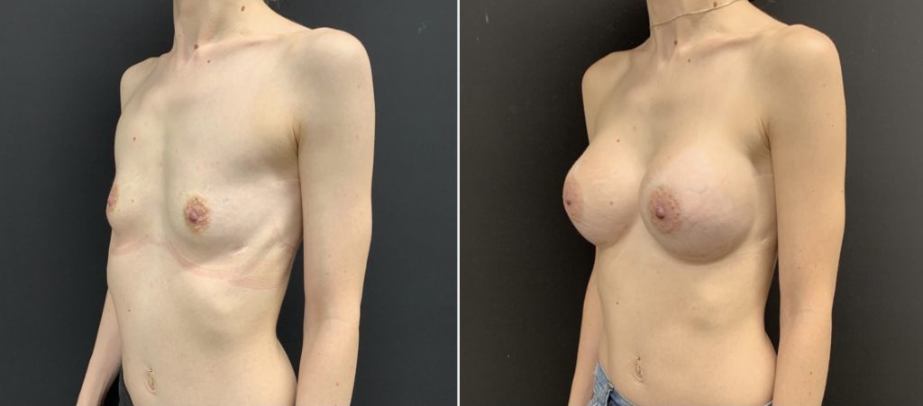 BREAST AUGMENTATION Before & After Case Number 00014