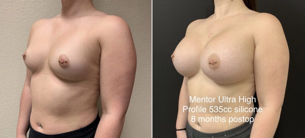 BREAST AUGMENTATION Before & After Case Number 00016