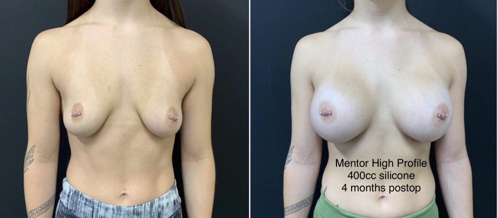 BREAST AUGMENTATION Before & After Case Number 00019