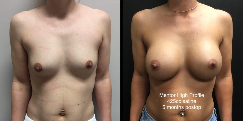 BREAST AUGMENTATION Before & After Case Number 00020