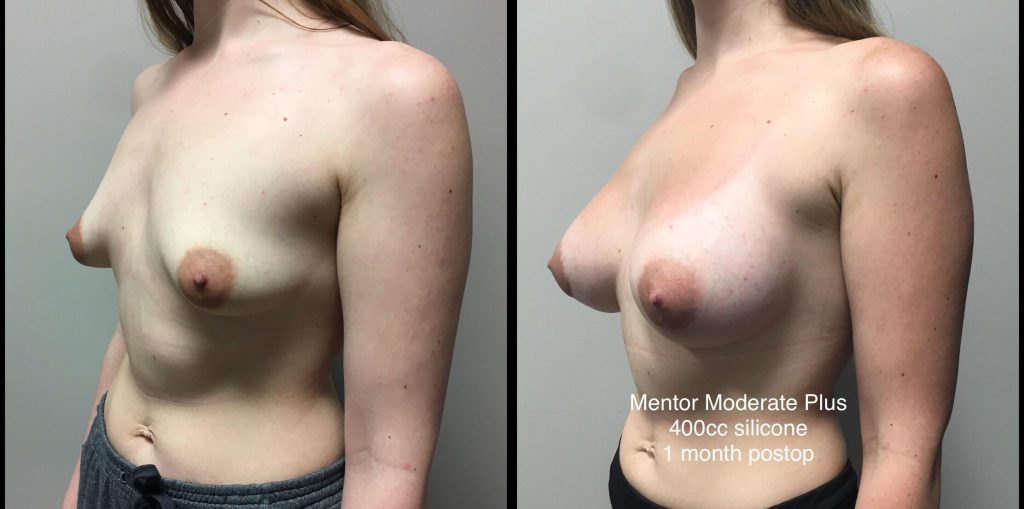 BREAST AUGMENTATION Before & After Case Number 00022