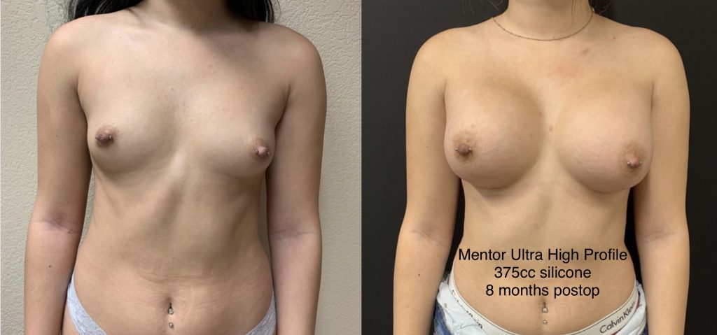 BREAST AUGMENTATION Before & After Case Number 00030