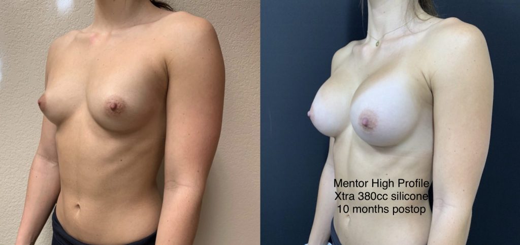 BREAST AUGMENTATION Before & After Case Number 00033