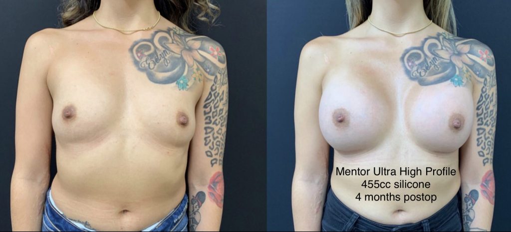 BREAST AUGMENTATION Before & After Case Number 00036