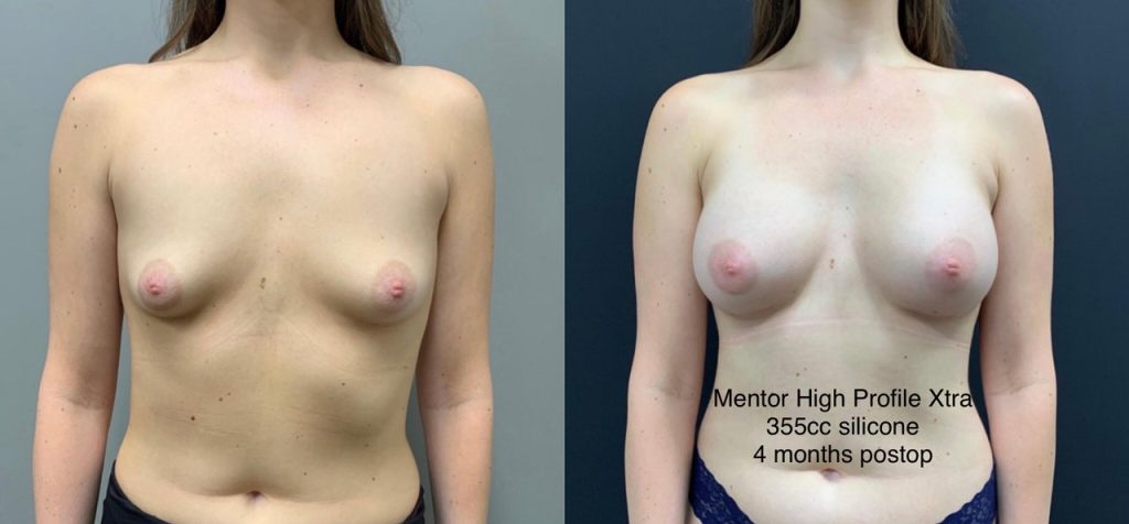 BREAST AUGMENTATION Before & After Case Number 00038