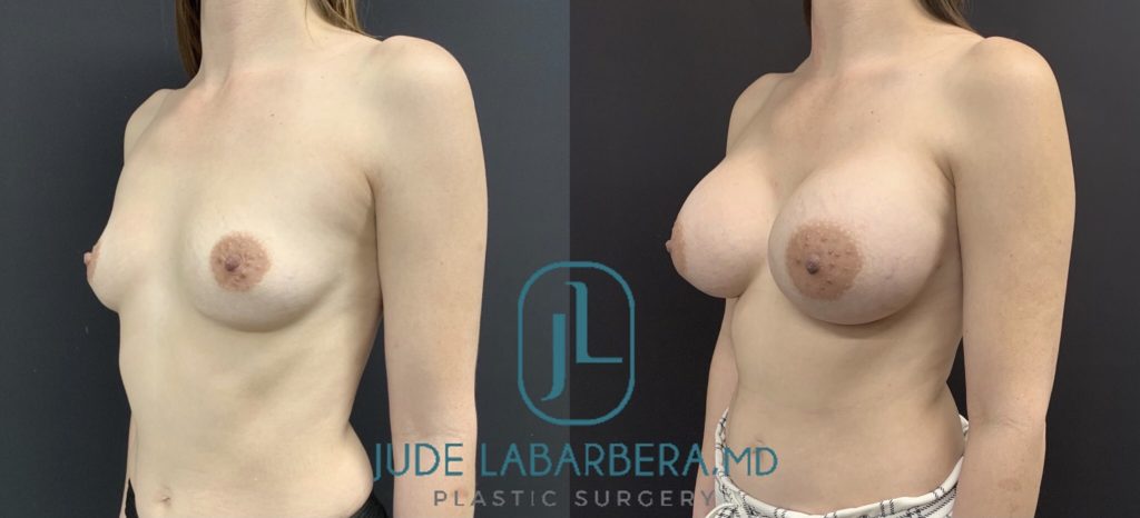 BREAST AUGMENTATION Before & After Case Number 00041