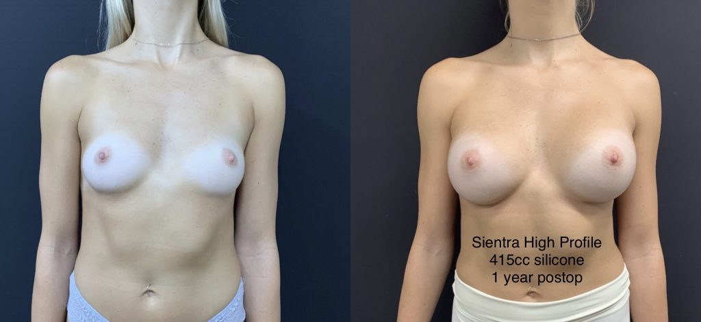 BREAST AUGMENTATION Before & After Case Number 00043
