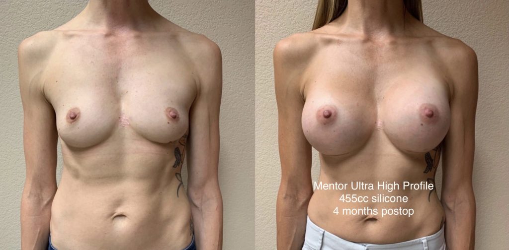 BREAST AUGMENTATION Before & After Case Number 00045