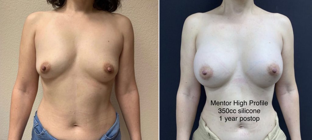BREAST AUGMENTATION Before & After Case Number 00046
