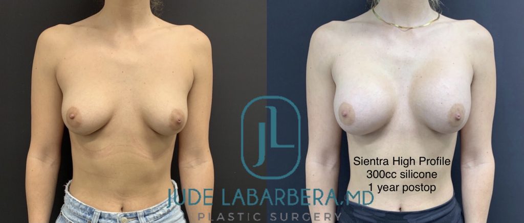 BREAST AUGMENTATION Before & After Case Number 00049