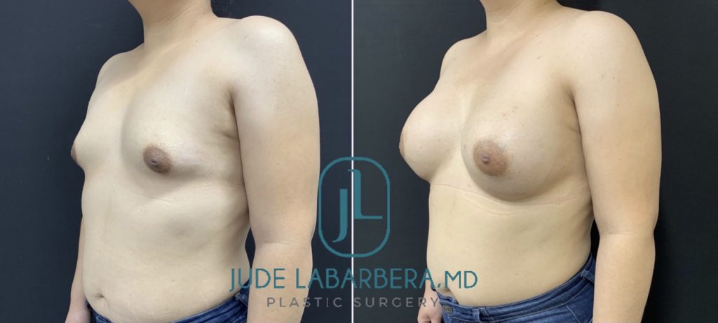 BREAST AUGMENTATION Before & After Case Number 00051