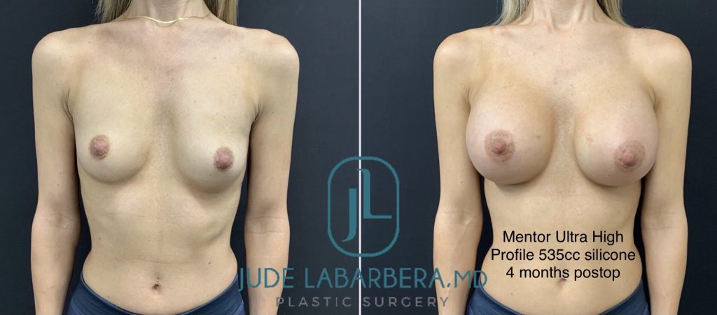 BREAST AUGMENTATION Before & After Case Number 00056