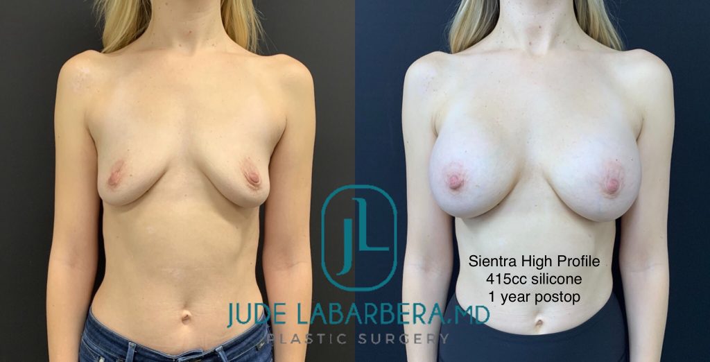 BREAST AUGMENTATION Before & After Case Number 00058