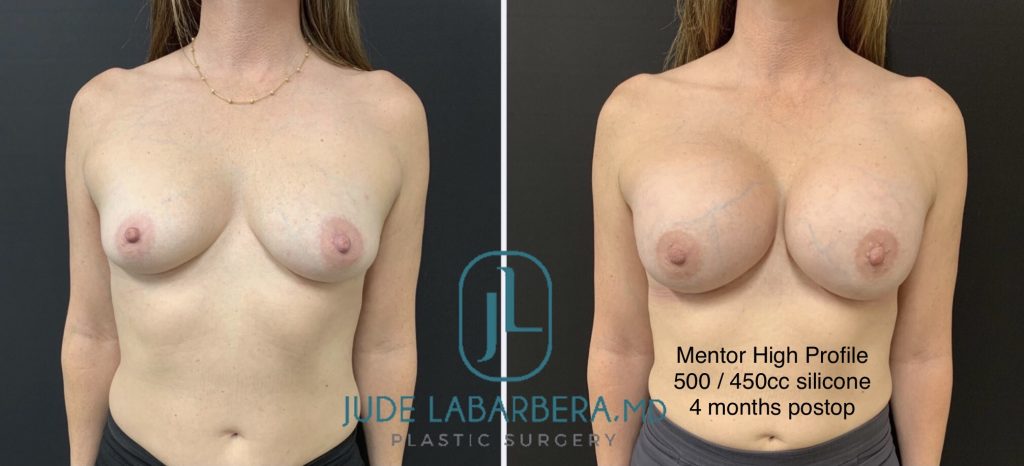 BREAST AUGMENTATION Before & After Case Number 0006