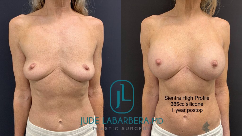 BREAST AUGMENTATION Before & After Case Number 00061