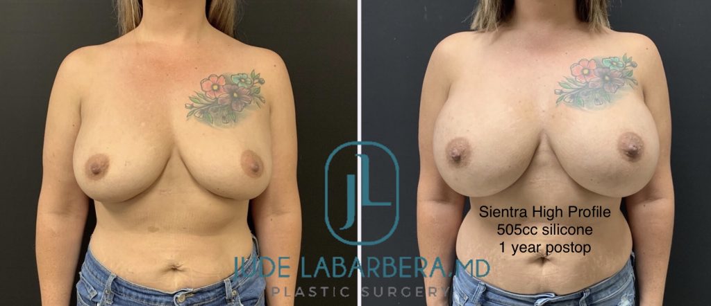 BREAST AUGMENTATION Before & After Case Number 00062