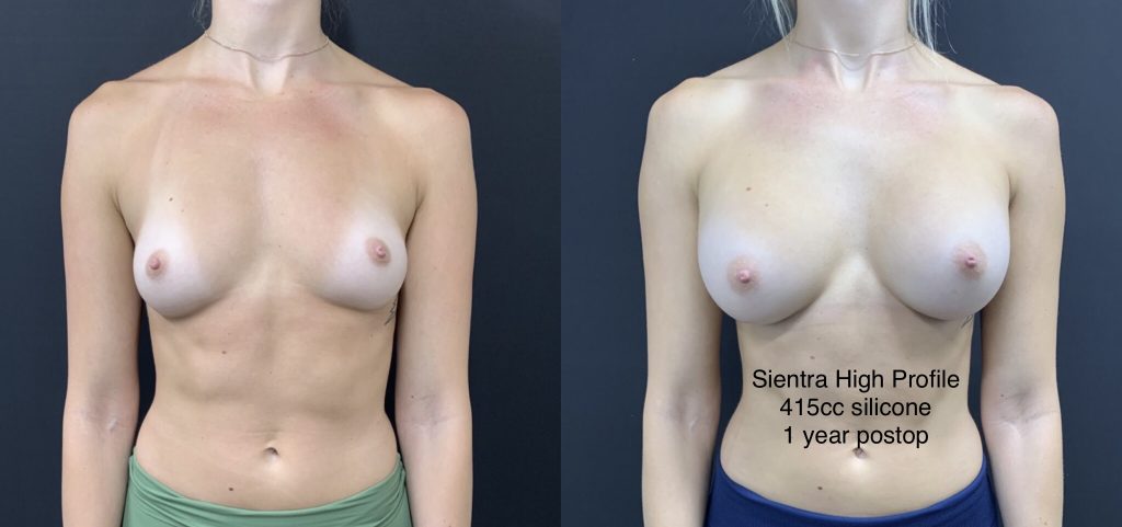 BREAST AUGMENTATION Before & After Case Number 00067