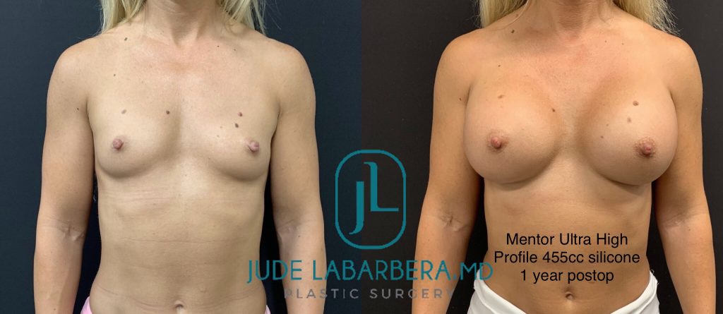 BREAST AUGMENTATION Before & After Case Number 00068