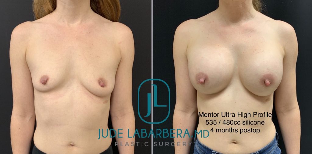 BREAST AUGMENTATION Before & After Case Number 00072