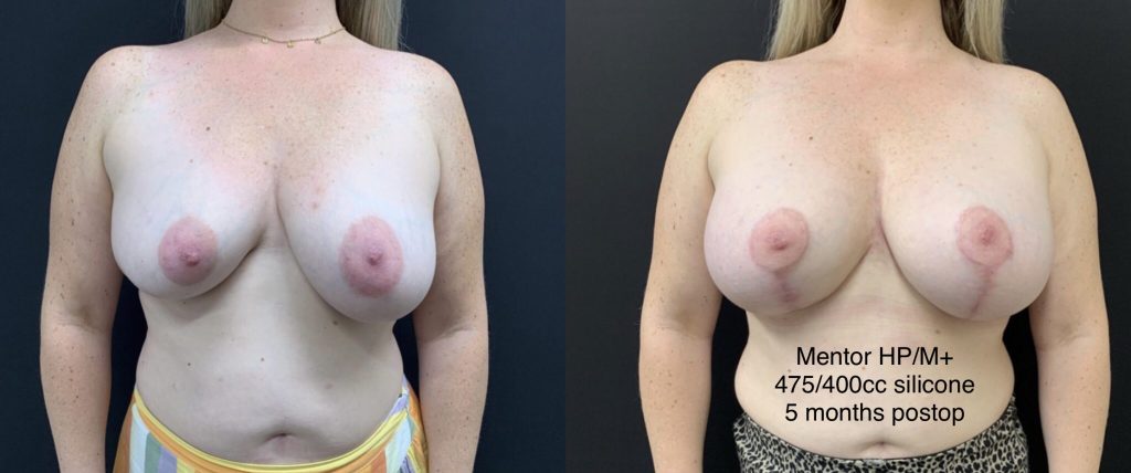 BREAST AUGMENTATION WITH LIFT Before & After Case Number 0003
