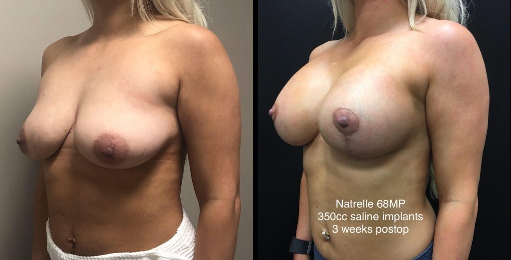 BREAST AUGMENTATION WITH LIFT Before & After Case Number 0006