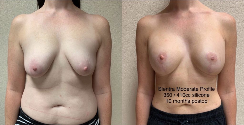 BREAST AUGMENTATION WITH LIFT Before & After Case Number 0007