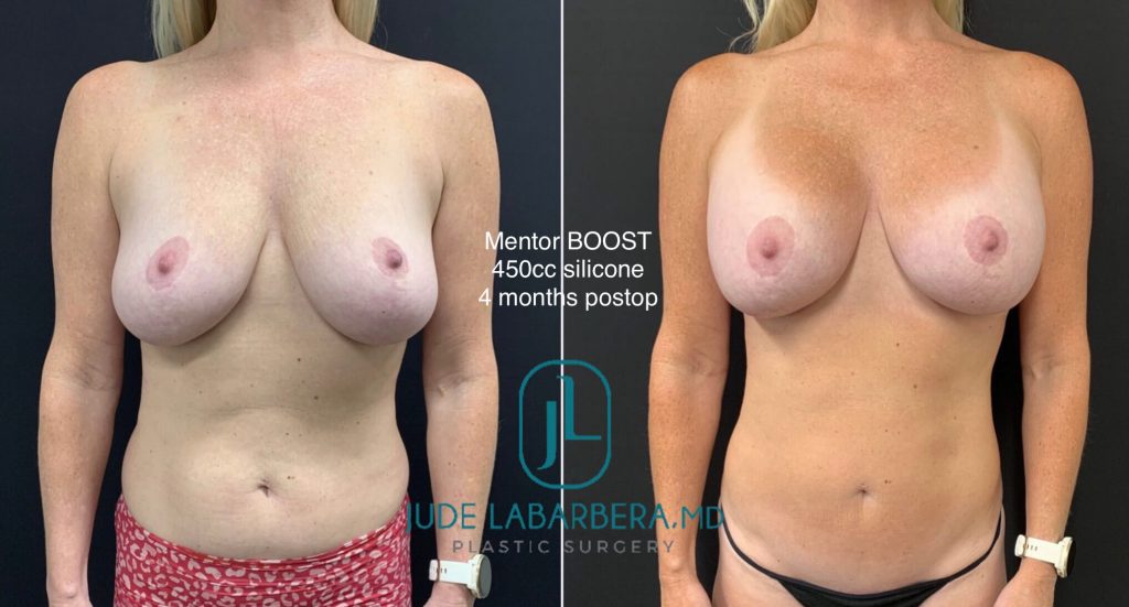 BREAST AUGMENTATION WITH REVISION LIFT AND MINI TUMMY TUCK Before & After Case Number 00064