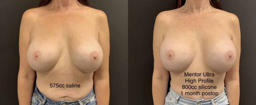 BREAST IMPLANT EXCHANGE Before & After Case Number 00010