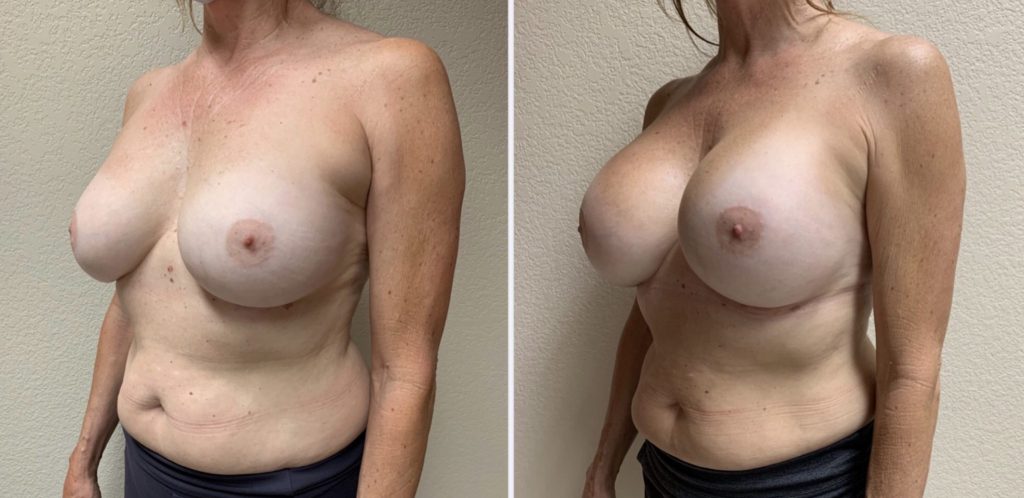 BREAST IMPLANT EXCHANGE Before & After Case Number 0008