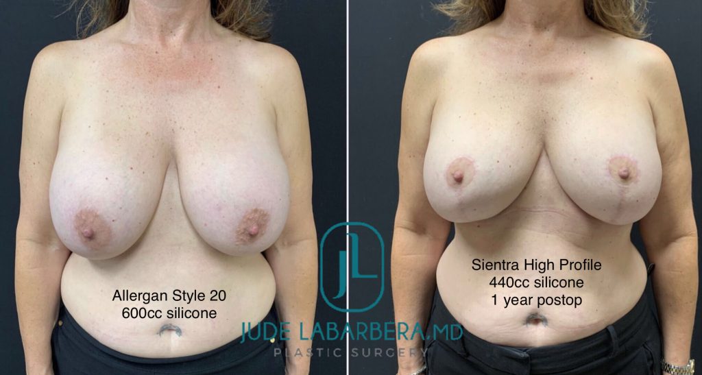 BREAST IMPLANT EXCHANGE WITH LIFT Before & After Case Number 00014