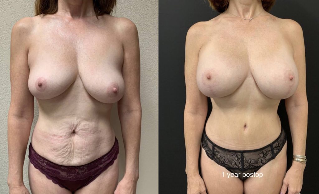 BREAST LIFT Before & After Case Number 0001
