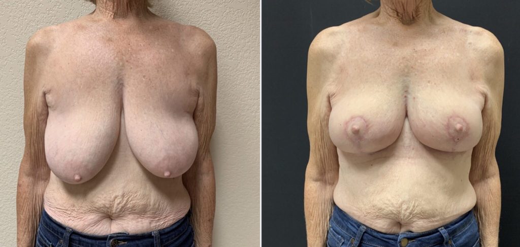 BREAST LIFT Before & After Case Number 00010