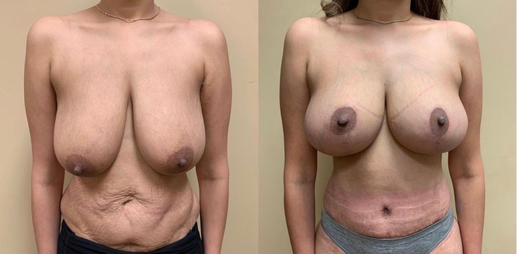 BREAST LIFT Before & After Case Number 0005-BL