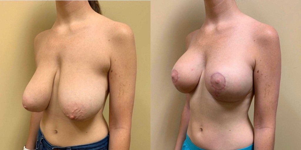 BREAST LIFT Before & After Case Number 0006