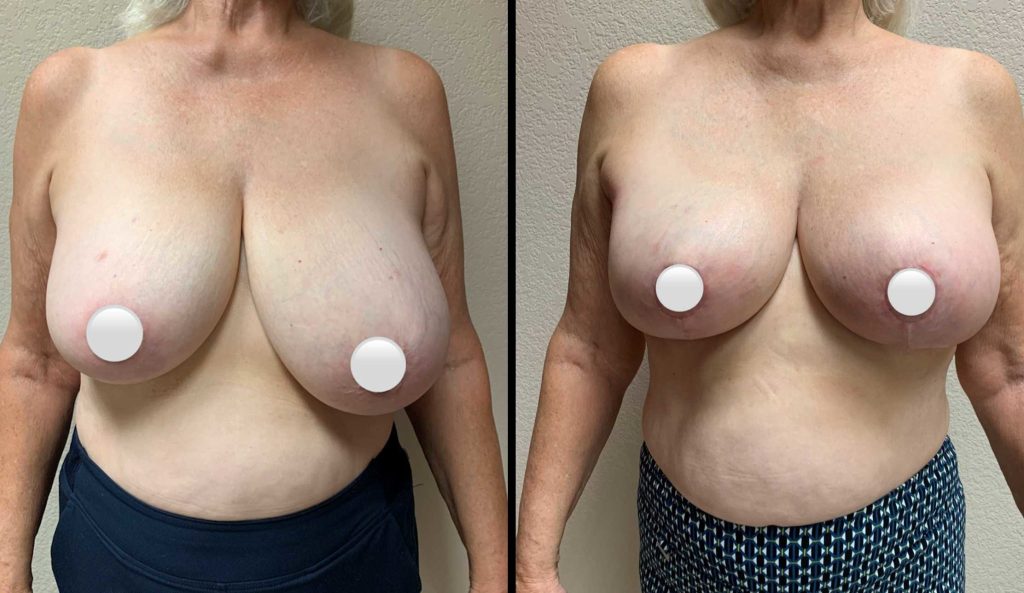 BREAST RECONSTRUCTION Before & After Case Number 0005