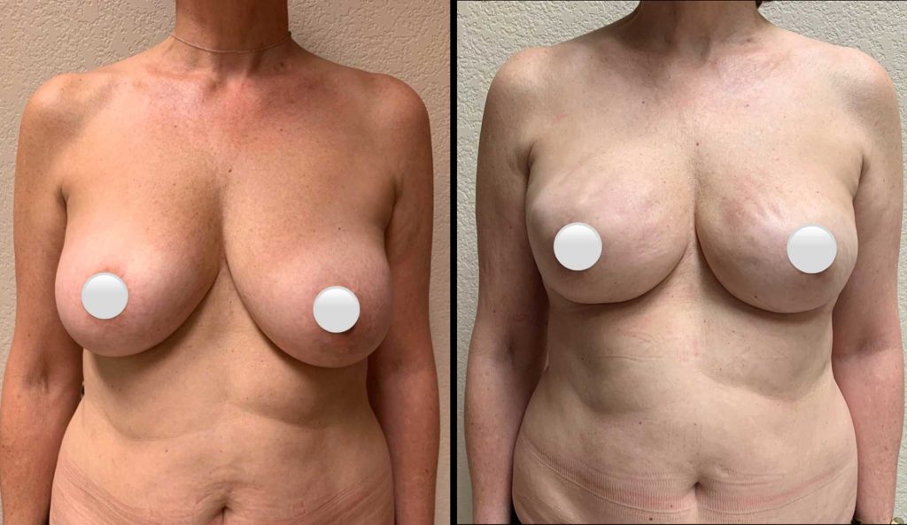 BREAST RECONSTRUCTION Before & After Case Number 0006