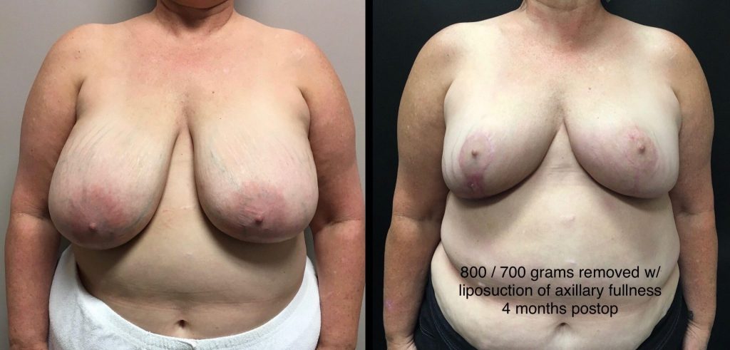 BREAST REDUCTION Before & After Case Number 0001