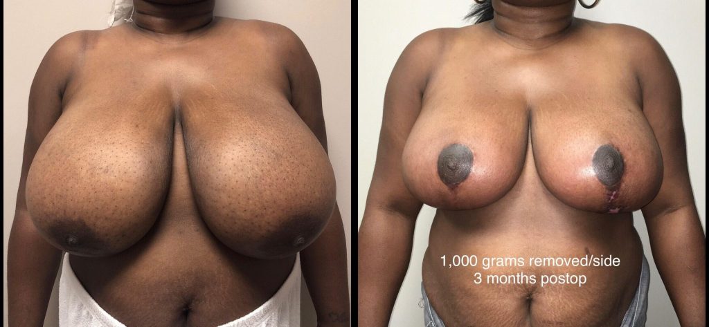 BREAST REDUCTION Before & After Case Number 0003