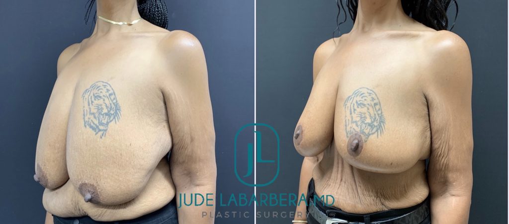 BREAST REDUCTION Before & After Case Number 0003