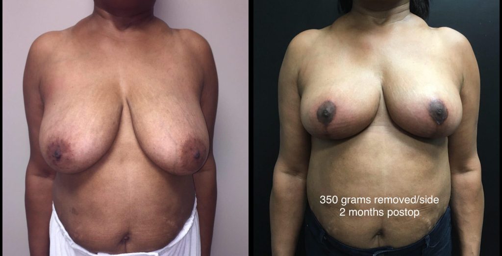 BREAST REDUCTION Before & After Case Number 0004