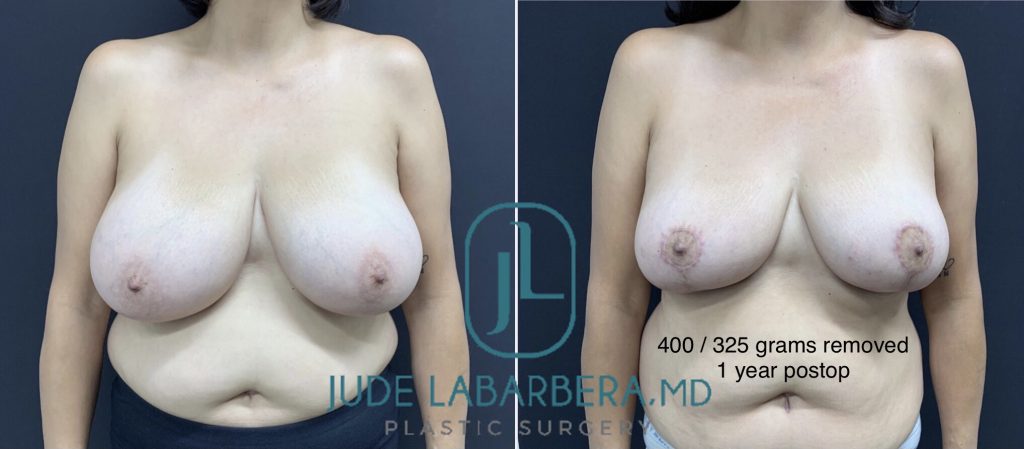 BREAST REDUCTION Before & After Case Number 0004