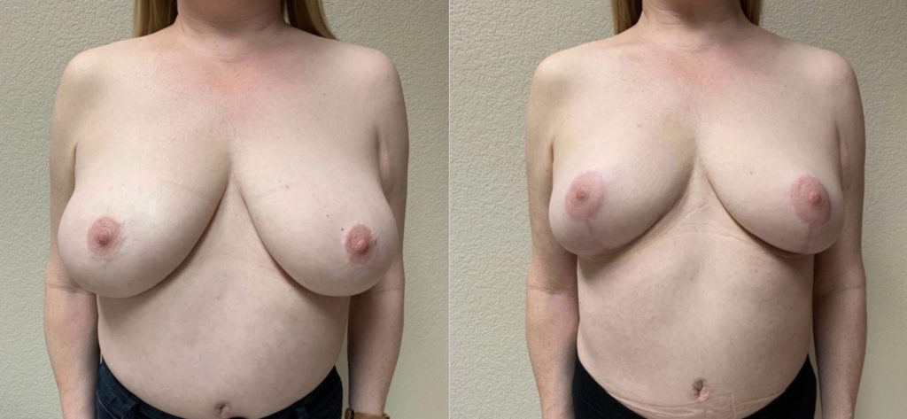BREAST REDUCTION Before & After Case Number 0004