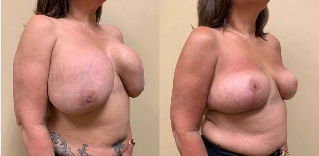 BREAST REVISION Before & After Case Number 0002