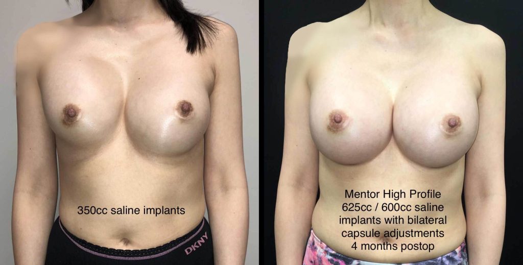 BREAST REVISION Before & After Case Number 0002